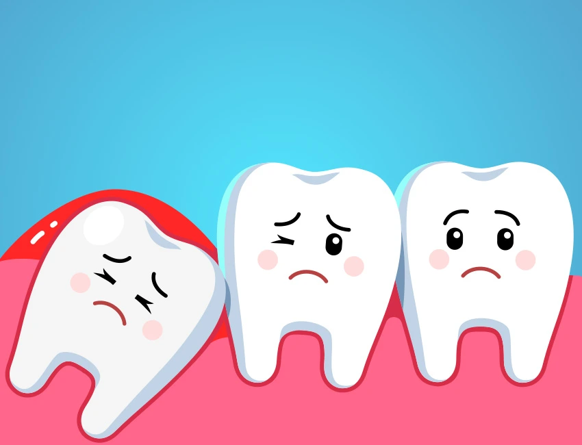 Graphic showing impacted wisdom tooth