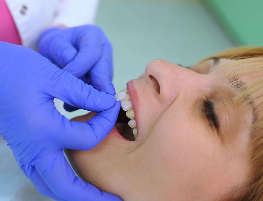 are veneers permanent