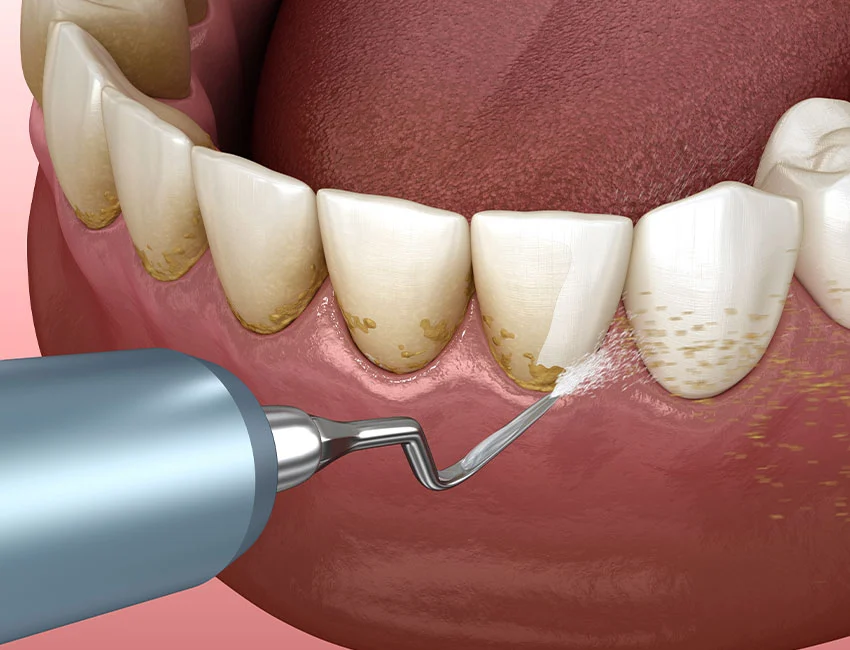 Limpiezas Dentales en West Hollywood Dental Studio