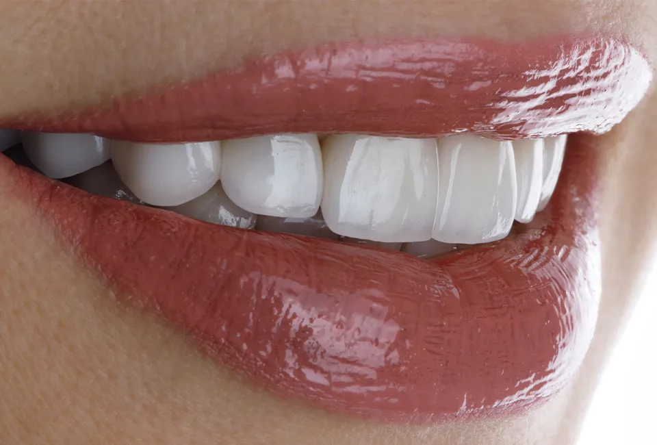 Patient beautiful smile after Veneers