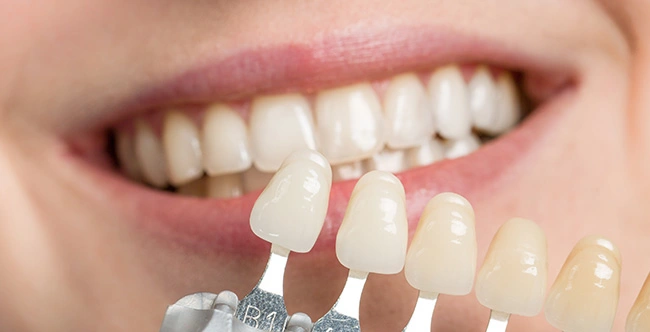 Dental veneers in West Hollywood, CA